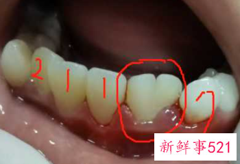 正常情况下人有几颗牙齿