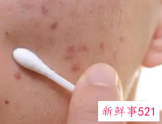 褐色痘印多久能自己消失