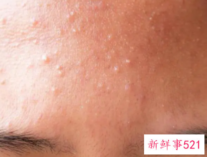 闭口什么样子图片