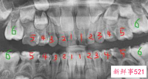 正常情况下人有几颗牙齿
