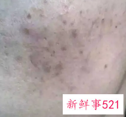 褐色痘印多久能自己消失