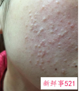 闭口什么样子图片