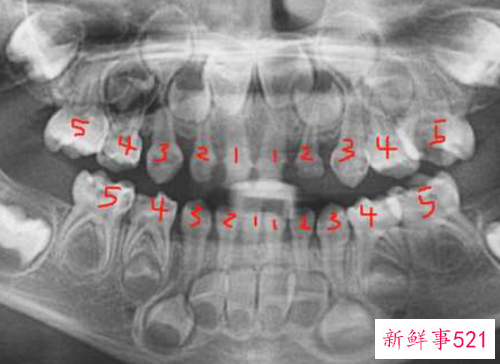 正常情况下人有几颗牙齿