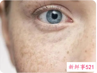 色素斑是什么原因引起的