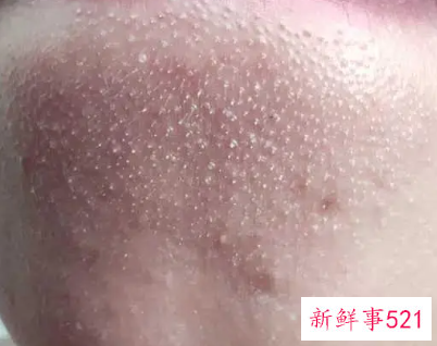 闭口什么样子图片