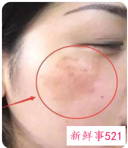 色素斑是什么原因引起的