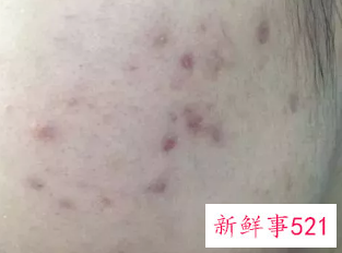 褐色痘印多久能自己消失