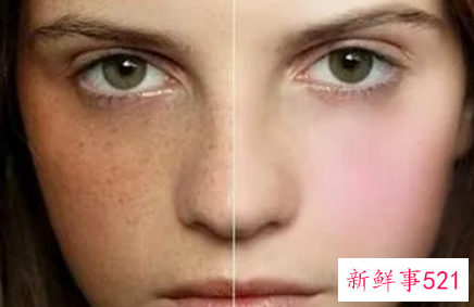 色素斑是什么原因引起的