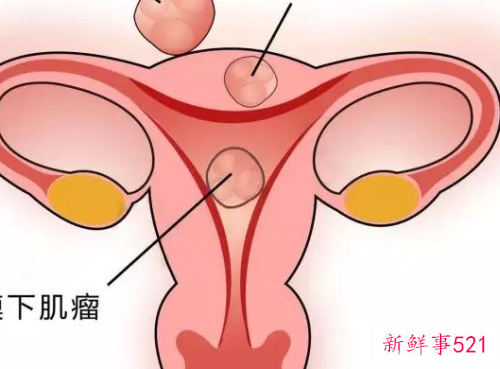 子宫肌瘤结节能自愈吗
