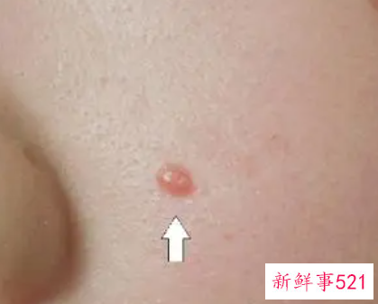 如何巧妙去掉痦子而不留疤痕