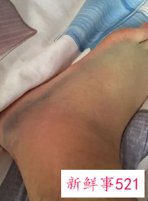 脚崴了七八年了还是疼