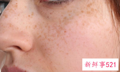 最有效的去除雀斑的方法是什么