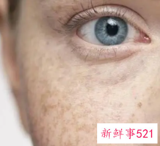 最有效的去除雀斑的方法是什么