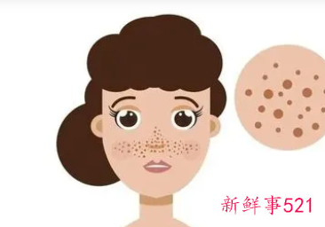 生完孩子脸上长斑怎么调理才能去掉