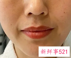 皮肤下垂法令纹严重怎么办