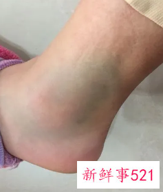 脚崴了七八年了还是疼