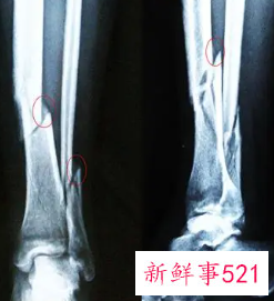 伤筋与骨折鉴别