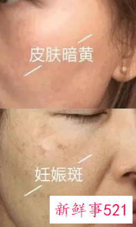 脸部色斑如何快速消除