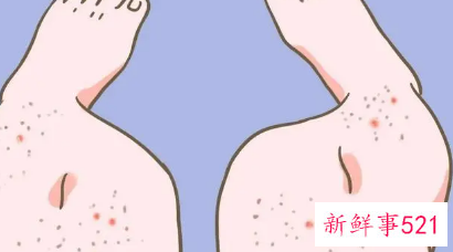 如何去腿上的鸡皮肤