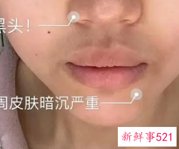 嘴角色素沉着能祛除吗