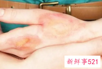 烫伤后离了凉水特别疼怎么缓解