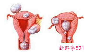 子宫肌瘤结节能自愈吗
