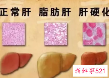 轻度脂肪肝可以自愈吗