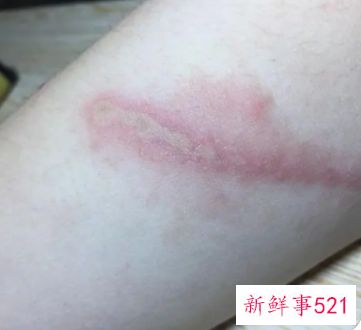 被不明虫子咬肿怎么办还很痛