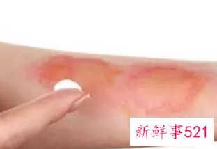 烫伤后离了凉水特别疼怎么缓解