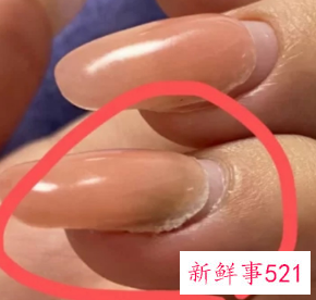 延长甲一般维持多久会自己掉吗