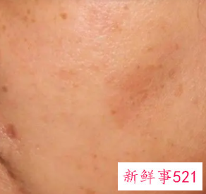 最有效的去除雀斑的方法是什么