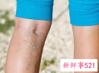 腿站久了会怎么样