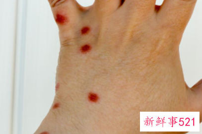 被不明虫子咬肿怎么办还很痛