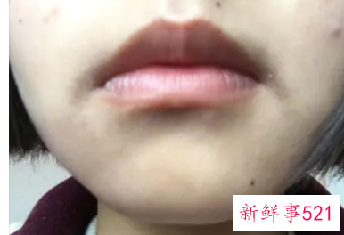 嘴角色素沉着能祛除吗