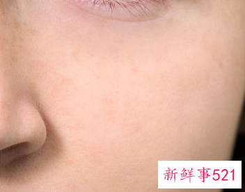 点斑结痂掉了后怎么护理