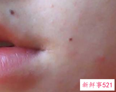 如何巧妙去掉痦子而不留疤痕