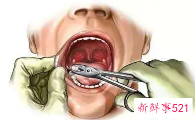 拔牙后多久可喝水吃饭刷牙