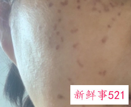 点斑结痂掉了后怎么护理