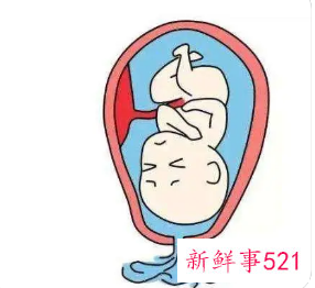 臀位破水来得及吗