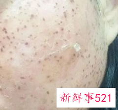 点斑结痂掉了后怎么护理