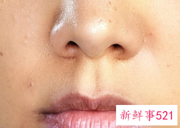 嘴角色素沉着能祛除吗