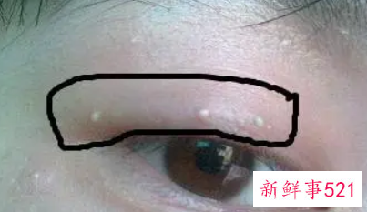 去除脸上脂肪粒的方法