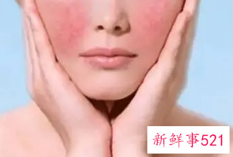 怎样改善脸上红血丝小妙招