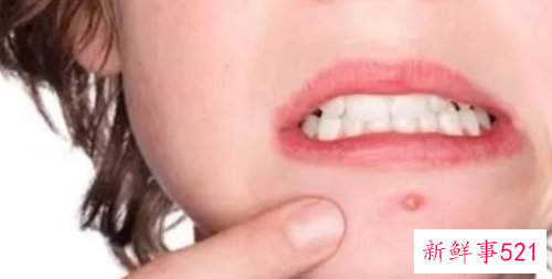 下巴白头粉刺的原因及预防方法