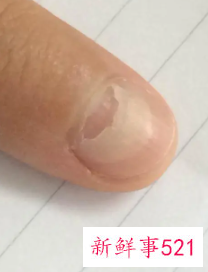 戴手套导致指甲分层