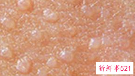 去除脸上脂肪粒的方法