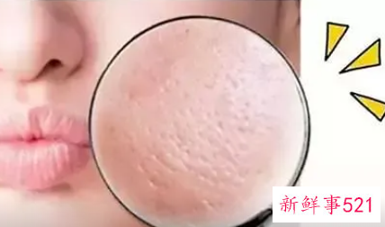 收缩毛孔有哪些方法远离草莓鼻