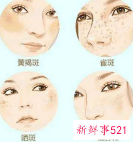 去除晒斑的好方法