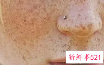 去除晒斑的好方法