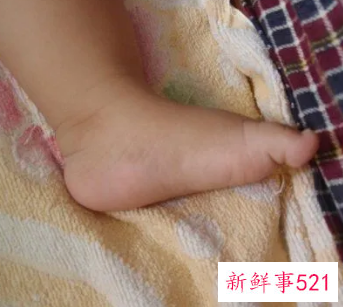 宝宝脚背红肿怎么缓解